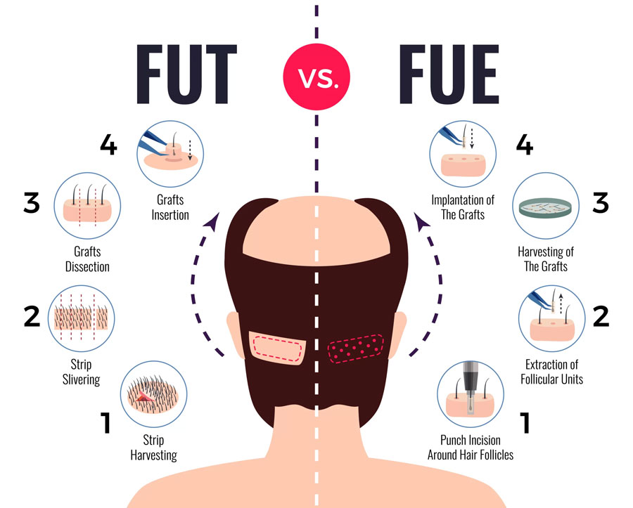 Fut-Vs-Fue